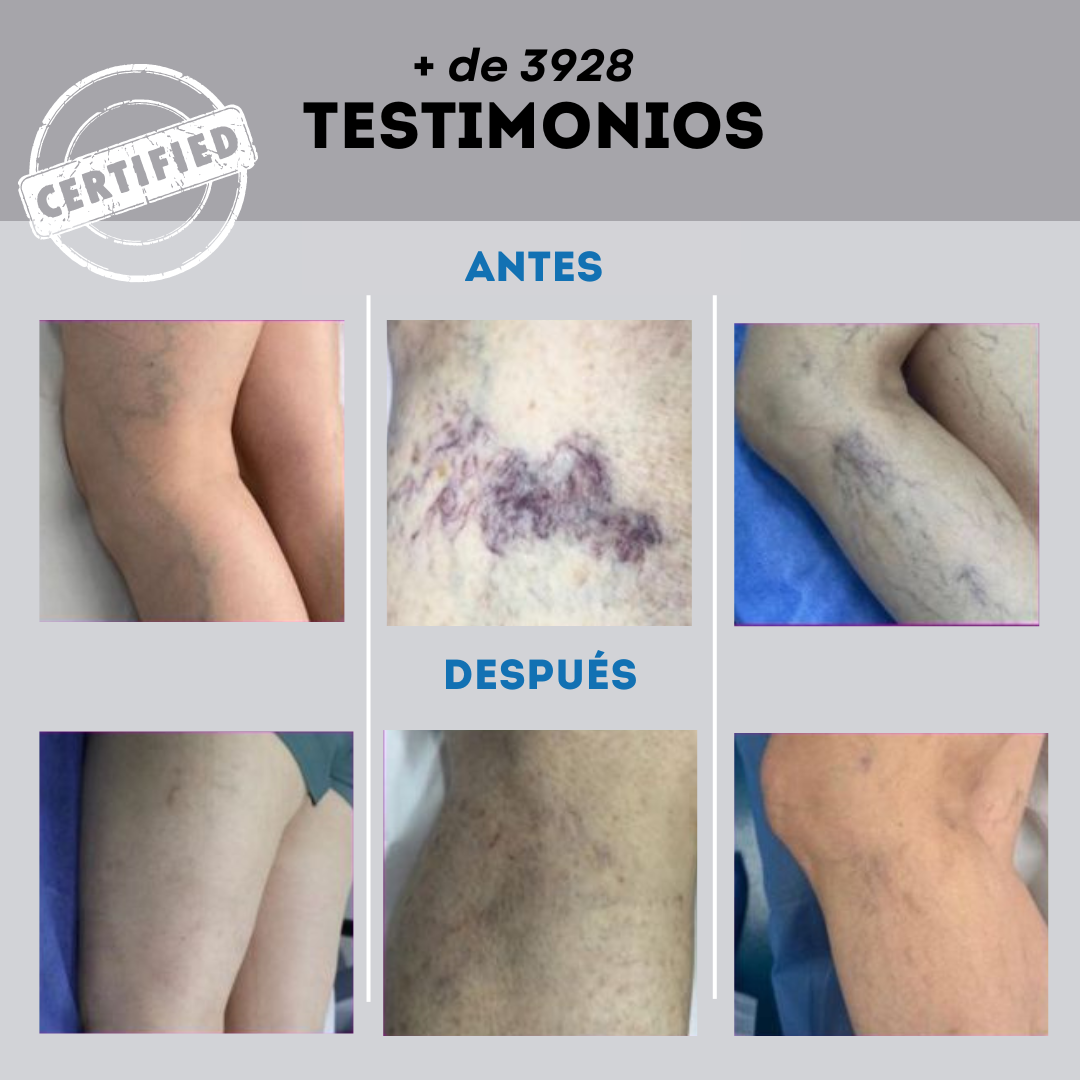 Varicose Veins™ | Elimina Venas Varices