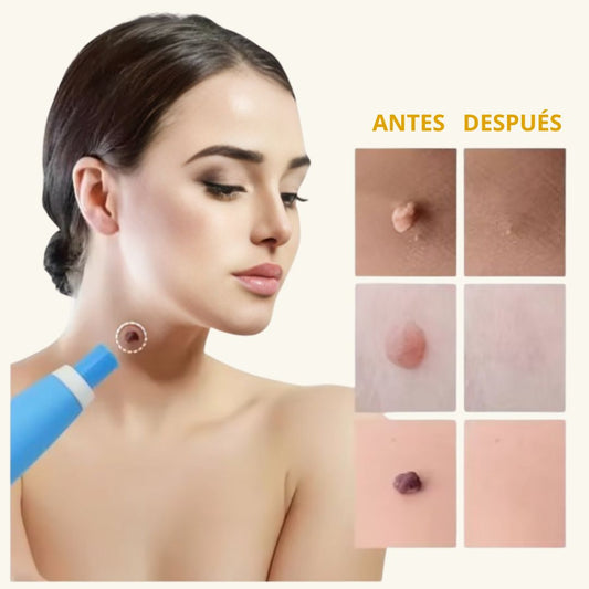 Kit Removedor de Verrugas y Marcas de la Piel